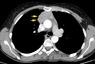Axial and sagital reconstruction from a contrast enhanced chest CT at the level of the ascending aorta demonstrates an anterior medastinal mass. The mass shows a small regions of heterogeneity with a low attenuation region, and abuts the anterior aspect of the pericardium. There is a lobulated contour that abuts the lung<strong>(arrows)</strong> . At surgery, the thymoma was found to invade the medaistinal fat as well as the right lung, without invasion into the aorta or other mediastinal vessels .